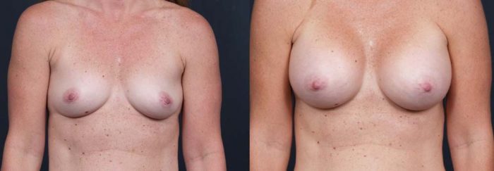 Breast Augmentation Patient 10a | Dr. Shaun Parson Plastic Surgery Scottsdale Arizona