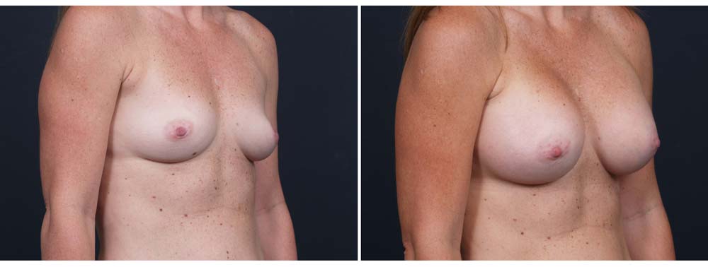 Breast Augmentation Patient 10b | Dr. Shaun Parson Plastic Surgery Scottsdale Arizona