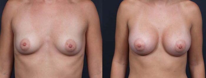 Breast Augmentation Patient 12a | Dr. Shaun Parson Plastic Surgery Scottsdale Arizona