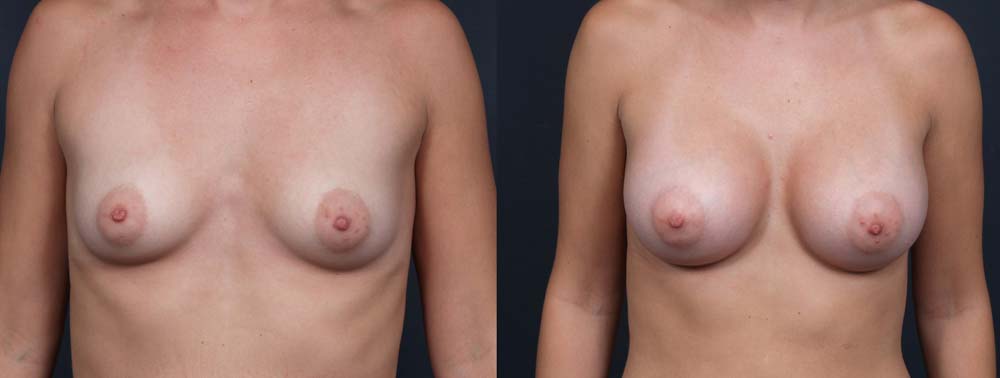 Breast Augmentation Patient 12a | Dr. Shaun Parson Plastic Surgery Scottsdale Arizona