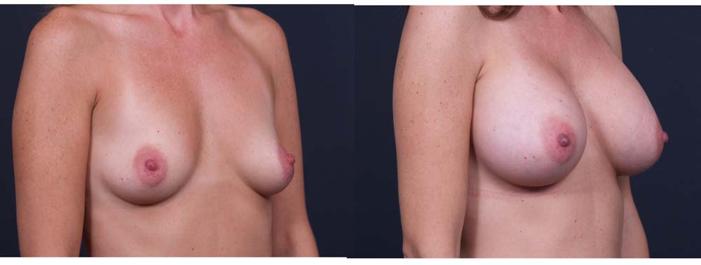 Breast Augmentation Patient 13b | Dr. Shaun Parson Plastic Surgery Scottsdale Arizona