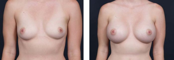 Breast Augmentation Patient 14a | Dr. Shaun Parson Plastic Surgery Scottsdale Arizona