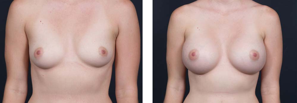 Breast Augmentation Patient 14a | Dr. Shaun Parson Plastic Surgery Scottsdale Arizona