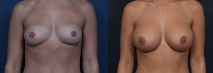 Breast Augmentation Patient 15a | Dr. Shaun Parson Plastic Surgery Scottsdale Arizona