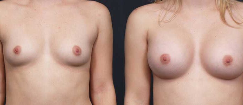 Breast Augmentation Patient 16a | Dr. Shaun Parson Plastic Surgery Scottsdale Arizona