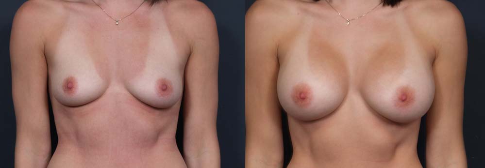 Breast Augmentation Patient 18a | Dr. Shaun Parson Plastic Surgery Scottsdale Arizona