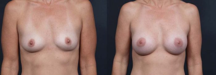 Breast Augmentation Patient 1a | Dr. Shaun Parson Plastic Surgery Scottsdale, Arizona