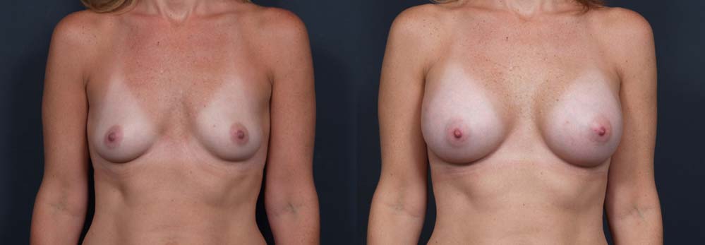 Breast Augmentation Patient 20a | Dr. Shaun Parson Plastic Surgery Scottsdale Arizona