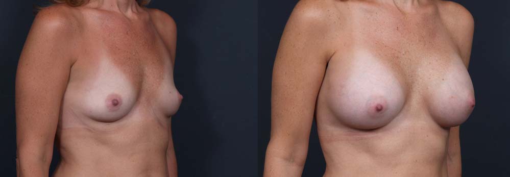 Breast Augmentation Patient 20a | Dr. Shaun Parson Plastic Surgery Scottsdale Arizona