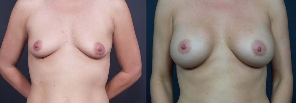 Breast Augmentation Patient 5a | Dr. Shaun Parson Plastic Surgery Scottsdale Arizona