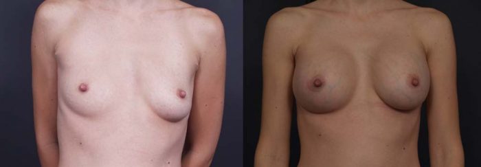 Breast Augmentation Patient 8a | Dr. Shaun Parson Plastic Surgery Scottsdale Arizona