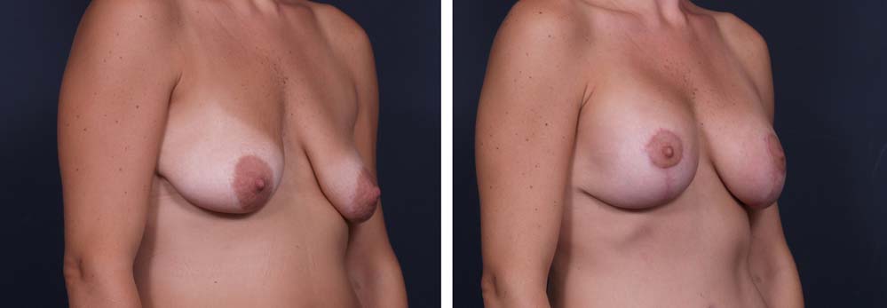 Breast Lift Aug Patient 12a | Dr. Shaun Parson Plastic Surgery Scottsdale Arizona