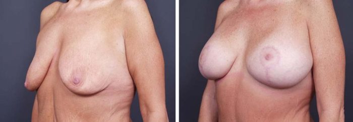 Breast Lift Aug Patient 14a | Dr. Shaun Parson Plastic Surgery Scottsdale Arizona