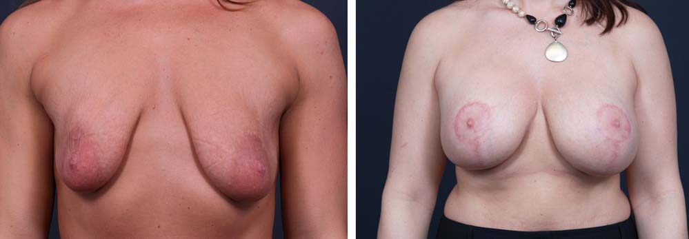 Breast Lift Aug Patient 15a | Dr. Shaun Parson Plastic Surgery Scottsdale Arizona