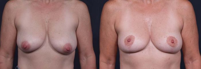 Breast Lift Patient 3a | Dr. Shaun Parson Plastic Surgery Scottsdale Arizona