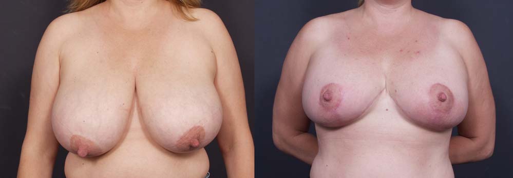 Breast Lift Patient 8a | Dr. Shaun Parson Plastic Surgery Scottsdale Arizona