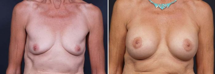 Breast Lift Peri Aug Patient 17 | Dr. Shaun Parson Plastic Surgery Scottsdale Arizona