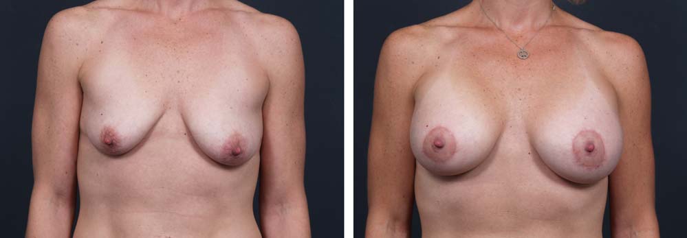 Breast Lift Peri Aug Patient 18 | Dr. Shaun Parson Plastic Surgery Scottsdale Arizona