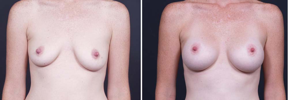 Breast Lift Peri Aug Patient 22a | Dr. Shaun Parson Plastic Surgery Scottsdale Arizona