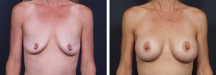 Breast Lift Peri Aug Patient 23a | Dr. Shaun Parson Plastic Surgery Scottsdale Arizona