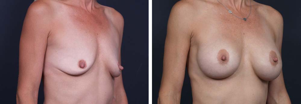 Breast Lift Peri Aug Patient 23a | Dr. Shaun Parson Plastic Surgery Scottsdale Arizona