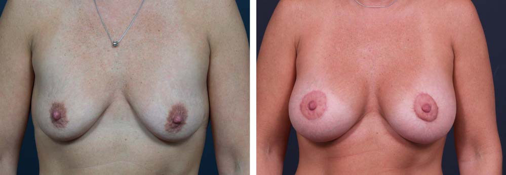 Breast Lift Peri Aug Patient 24a | Dr. Shaun Parson Plastic Surgery Scottsdale Arizona