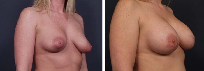 Breast Lift with Peri-Areolar Augmentation Patient 26 | Dr. Shaun Parson Plastic Surgery Scottsdale Arizona