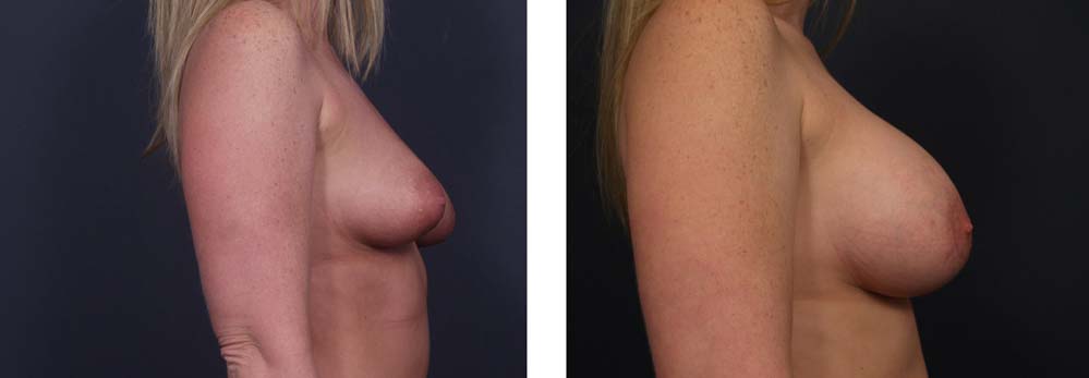 Breast Lift Peri Aug Patient 26 | Dr. Shaun Parson Plastic Surgery Scottsdale Arizona