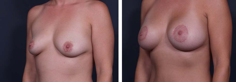 Breast Lift Peri Aug Patient 27a | Dr. Shaun Parson Plastic Surgery Scottsdale Arizona