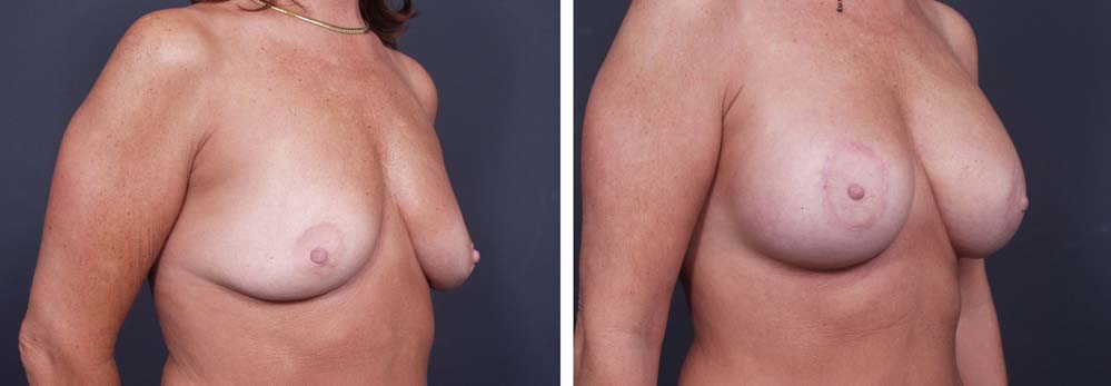 Breast Lift Peri Aug Patient 28a | Dr. Shaun Parson Plastic Surgery Scottsdale Arizona