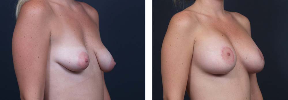 Breast Lift Peri Aug Patient 29a | Dr. Shaun Parson Plastic Surgery Scottsdale Arizona