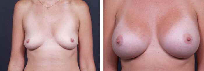 Breast Lift Peri Aug Patient 30a | Dr. Shaun Parson Plastic Surgery Scottsdale Arizona