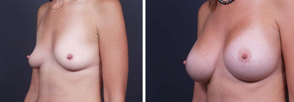 Breast Lift Peri Aug Patient 30a | Dr. Shaun Parson Plastic Surgery Scottsdale Arizona