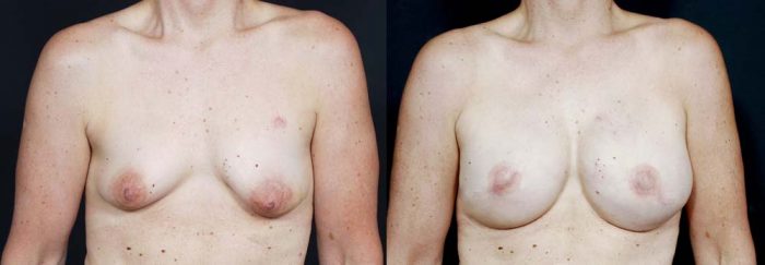 Breast Reconstruction Patient 10 | Dr. Shaun Parson Plastic Surgery Scottsdale Arizona