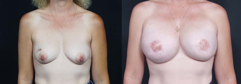 Breast Reconstruction Patient 11 | Dr. Shaun Parson Plastic Surgery Scottsdale Arizona