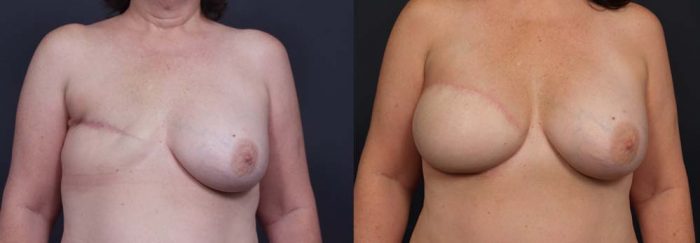 Breast Reconstruction Patient 12 | Dr. Shaun Parson Plastic Surgery Scottsdale Arizona