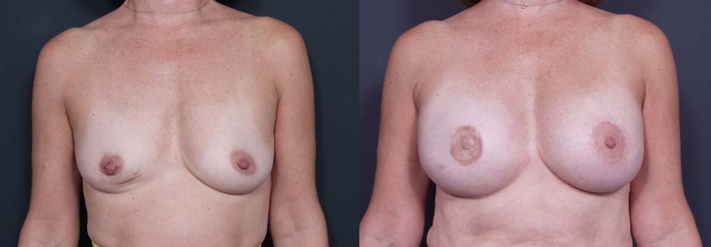 Breast Reconstruction Patient 2 | Dr. Shaun Parson Plastic Surgery Scottsdale Arizona