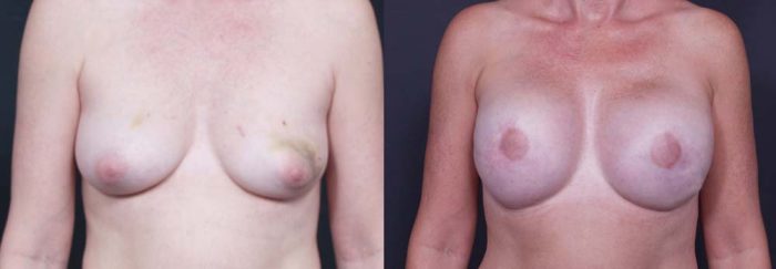 Breast Reconstruction Patient 3 | Dr. Shaun Parson Plastic Surgery Scottsdale Arizona