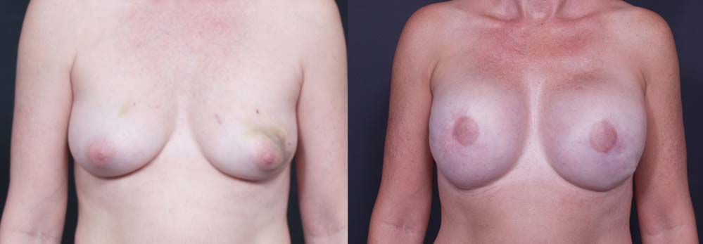 Breast Reconstruction Patient 3 | Dr. Shaun Parson Plastic Surgery Scottsdale Arizona