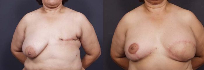 Breast Reconstruction Patient 4 | Dr. Shaun Parson Plastic Surgery Scottsdale Arizona