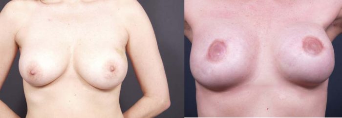 Breast Reconstruction Patient 6 | Dr. Shaun Parson Plastic Surgery Scottsdale Arizona