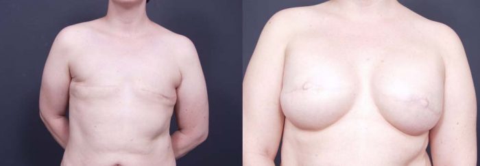 Breast Reconstruction Patient 7 | Dr. Shaun Parson Plastic Surgery Scottsdale Arizona