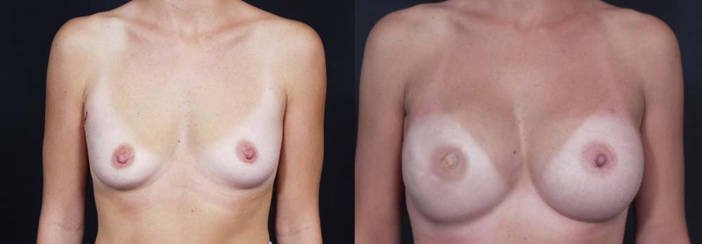 Breast Reconstruction Patient 9 | Dr. Shaun Parson Plastic Surgery Scottsdale Arizona