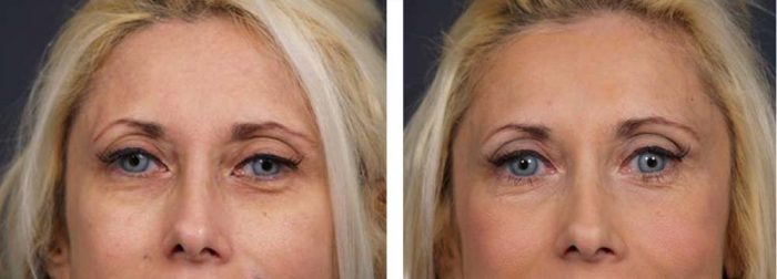 Brow Lift Patient 2 | Dr. Shaun Parson Plastic Surgery Scottsdale Arizona