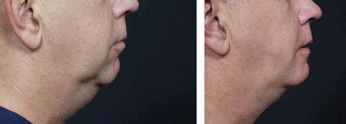 Chin Aug Patient 1 | Dr. Shaun Parson Plastic Surgery Scottsdale Arizona