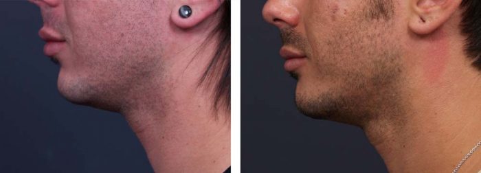 Chin Aug Patient 2 | Dr. Shaun Parson Plastic Surgery Scottsdale Arizona