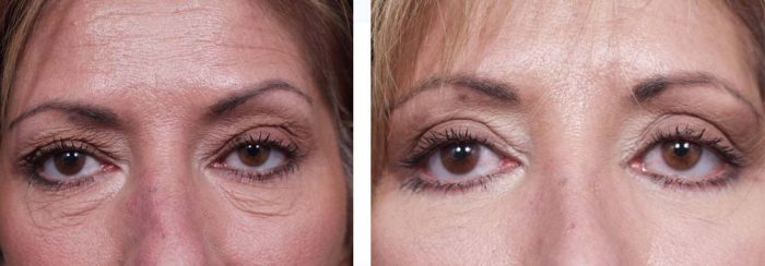 Eyelid Surgery Patient 2 | Dr. Shaun Parson Plastic Surgery Scottsdale Arizona