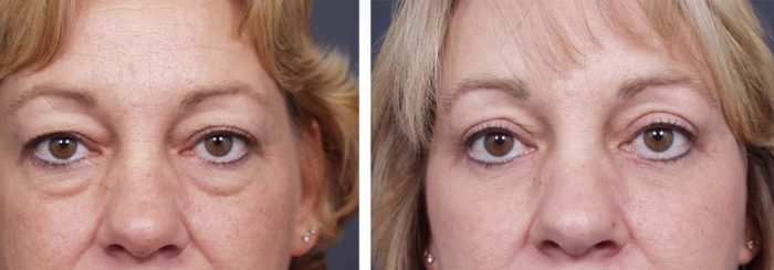 Eyelid Surgery Patient 3 | Dr. Shaun Parson Plastic Surgery Scottsdale Arizona