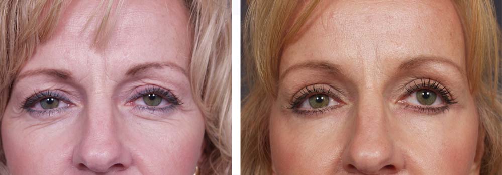 Eyelid Surgery Patient 5 | Dr. Shaun Parson Plastic Surgery Scottsdale Arizona