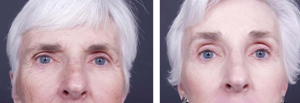 Facelift Patient 1a | Dr. Shaun Parson Plastic Surgery Scottsdale Arizona